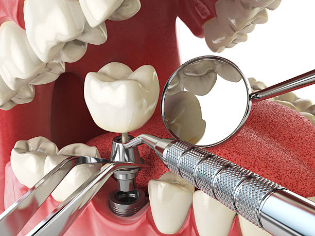 Best Emergency Root Canal Therapy in Ringgold, GA
